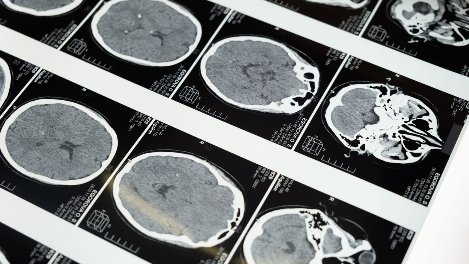 Alzheimer’s Stigma Delays Care for Indian Families